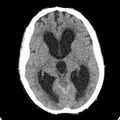 Cerebellar abscess secondary to mastoiditis (Radiopaedia 26284-26412 Axial non-contrast 76).jpg