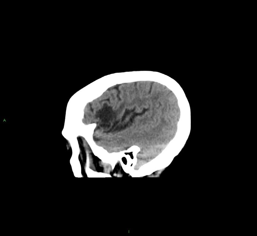 Cerebellar hemorrhage (Radiopaedia 58793-66027 C 12).jpg