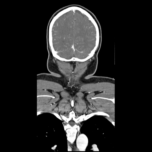 File:Cerebellar infarct due to vertebral artery dissection with posterior fossa decompression (Radiopaedia 82779-97029 D 53).png