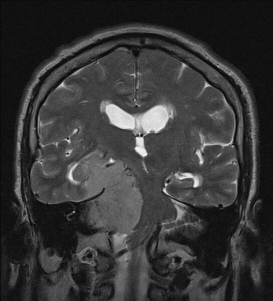 File:Cerebellopontine angle meningioma (Radiopaedia 24459-24764 Coronal T2 13).jpg