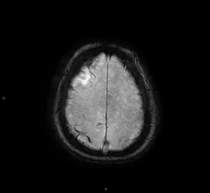 Cerebral amyloid angiopathy-associated lobar intracerebral hemorrhage (Radiopaedia 58378-65517 Axial SWI 61).jpg