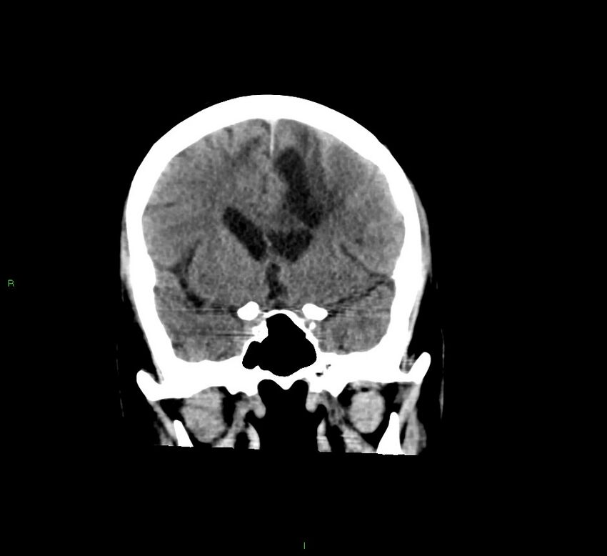 Cerebral amyloid angiopathy-associated lobar intracerebral hemorrhage (Radiopaedia 58529-65681 Coronal non-contrast 43).jpg