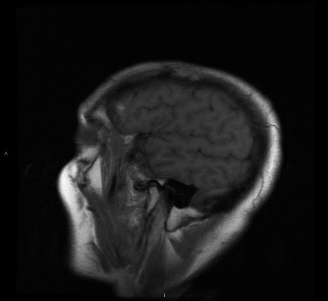 File:Cerebral amyloid angiopathy-associated lobar intracerebral hemorrhage (Radiopaedia 58529-65684 Sagittal T1 20).jpg