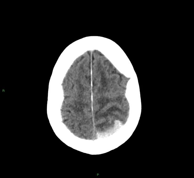 File:Cerebral amyloid angiopathy-associated lobar intracerebral hemorrhage (Radiopaedia 58530-65688 Axial non-contrast 9).jpg