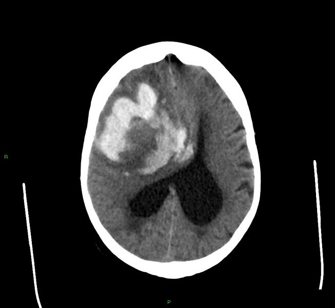 File:Cerebral amyloid angiopathy-associated lobar intracerebral hemorrhage (Radiopaedia 58560-65723 Axial non-contrast 20).jpg