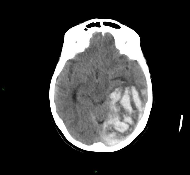 File:Cerebral amyloid angiopathy-associated lobar intracerebral hemorrhage (Radiopaedia 58754-65975 Axial non-contrast 38).jpg