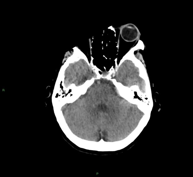 File:Cerebral amyloid angiopathy-associated lobar intracerebral hemorrhage (Radiopaedia 58754-65975 Axial non-contrast 44).jpg