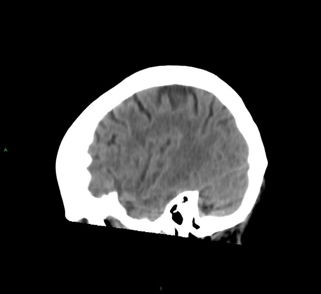 File:Cerebral amyloid angiopathy-associated lobar intracerebral hemorrhage (Radiopaedia 58754-65975 C 11).jpg