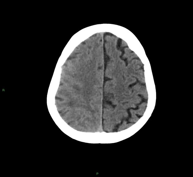 File:Cerebral amyloid angiopathy-associated lobar intracerebral hemorrhage (Radiopaedia 58758-65980 Axial non-contrast 13).jpg