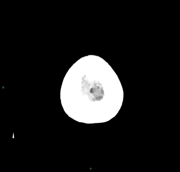 File:Cerebral amyloid angiopathy-associated lobar intracerebral hemorrhage (Radiopaedia 59356-66716 Axial non-contrast 3).jpg