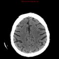 Cerebral and orbital tuberculomas (Radiopaedia 13308-13310 Axial non-contrast 21).jpg