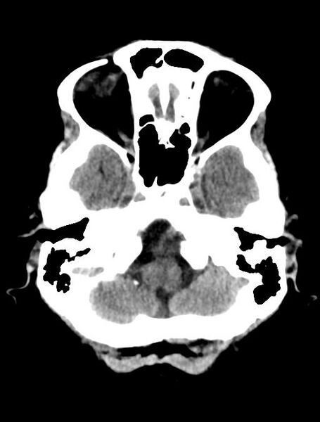 File:Cerebral aneurysm with rupture (Radiopaedia 29933-30457 Axial non-contrast 4).jpg