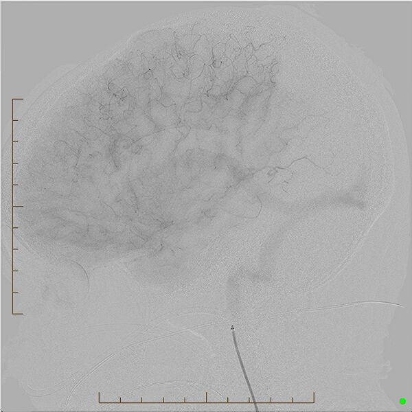 File:Cerebral arteriovenous malformation (AVM) (Radiopaedia 78162-90707 B 14).jpg