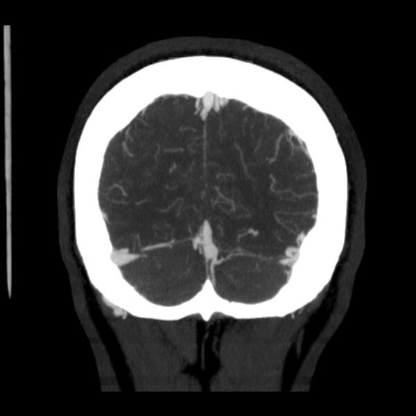 File:Cerebral arteriovenous malformation (Radiopaedia 43729-47189 C 41).jpg