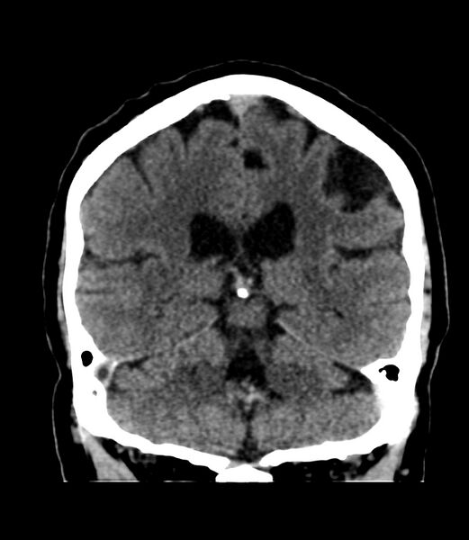 File:Cerebral dural venous sinus thrombosis (Radiopaedia 86514-102575 Coronal non-contrast 32).jpg