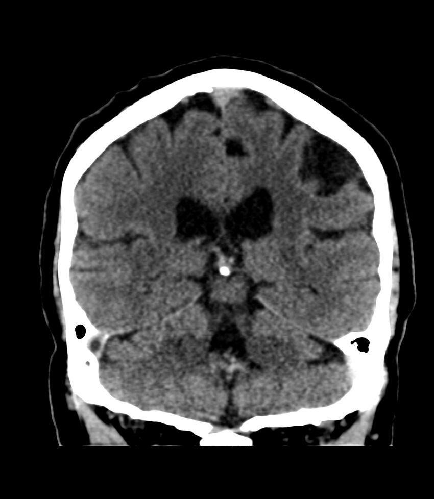 Cerebral dural venous sinus thrombosis (Radiopaedia 86514-102575 Coronal non-contrast 32).jpg