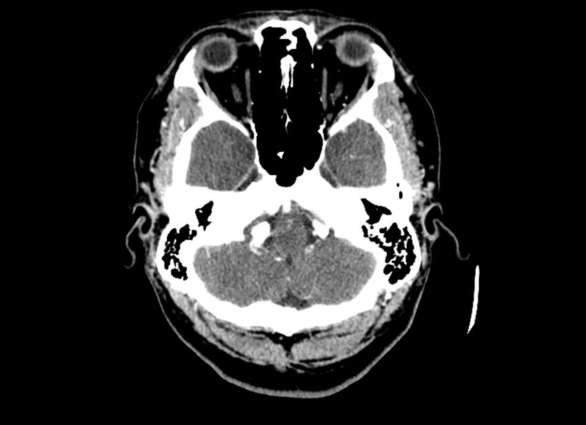 Cerebral edema (Radiopaedia 82519-96661 B 47).jpg