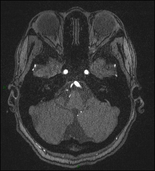 File:Cerebral fat embolism (Radiopaedia 35022-36525 Axial TOF 39).jpg