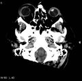 Cerebral hemorrhagic contusion with subdural and subarachnoid hemorrhage (Radiopaedia 10680-11146 Axial non-contrast 2).jpg