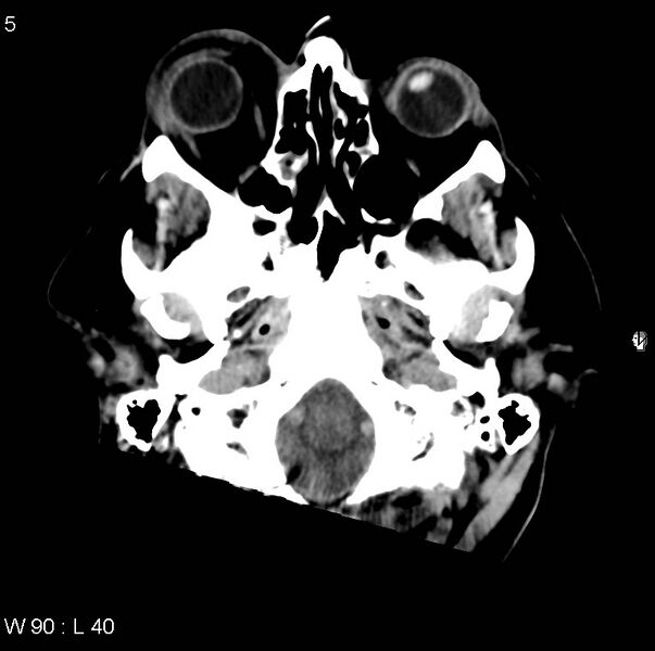 File:Cerebral hemorrhagic contusion with subdural and subarachnoid hemorrhage (Radiopaedia 10680-11146 Axial non-contrast 2).jpg