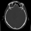 Cerebral hemorrhagic contusions (Radiopaedia 23145-23188 Axial bone window 22).jpg