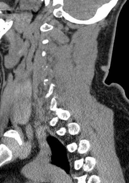File:Cerebral hemorrhagic contusions and cervical spine fractures (Radiopaedia 32865-33841 G 39).jpg