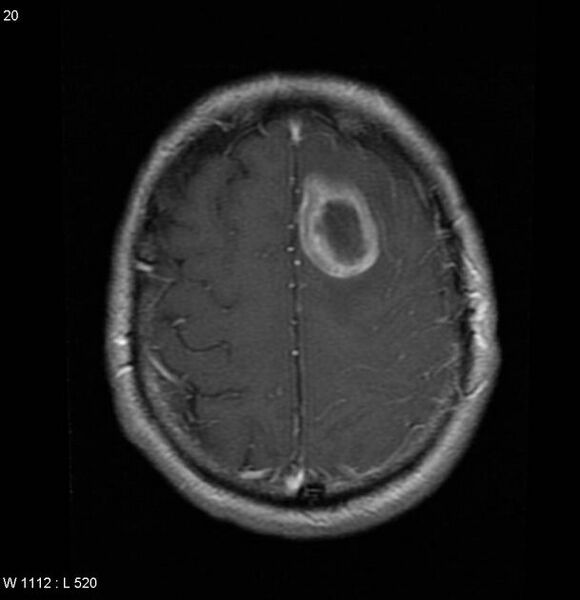 File:Cerebral metastases - renal cell carcinoma (Radiopaedia 5510-7246 Axial T1 C+ 1).jpg