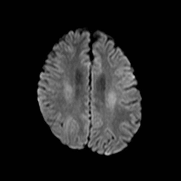 File:Cerebral tuberculoma (Radiopaedia 41152-43932 Axial DWI 16).jpg