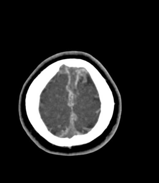 File:Cerebral venous sinus thrombosis (Radiopaedia 59224-66646 Axial C+ delayed 4).jpg
