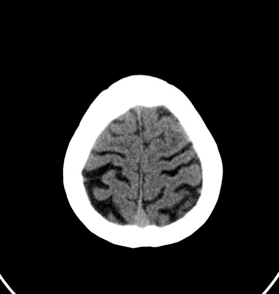 File:Cerebral venous thrombosis - CT only (Radiopaedia 41031-43778 Axial non-contrast 6).jpg