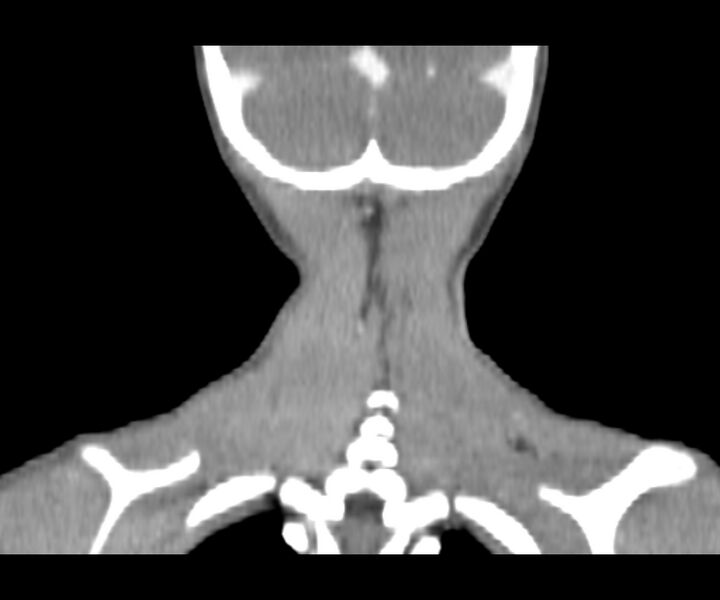 File:Cervical cystic lymphangioma (Radiopaedia 63655-72332 Coronal + contrast 31).jpg