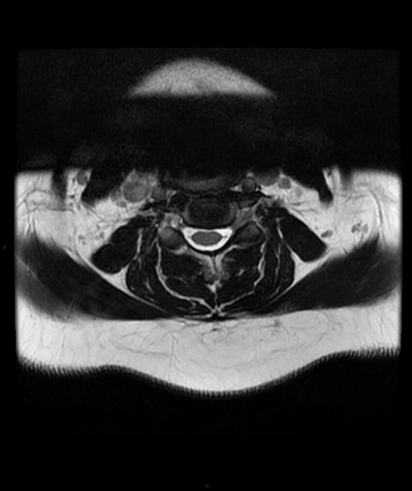 Cervical disc prolapse (Radiopaedia 80258-93598 Axial T2 26).jpg