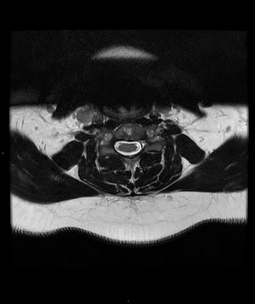 Cervical disc prolapse (Radiopaedia 80258-93598 Axial T2 33).jpg
