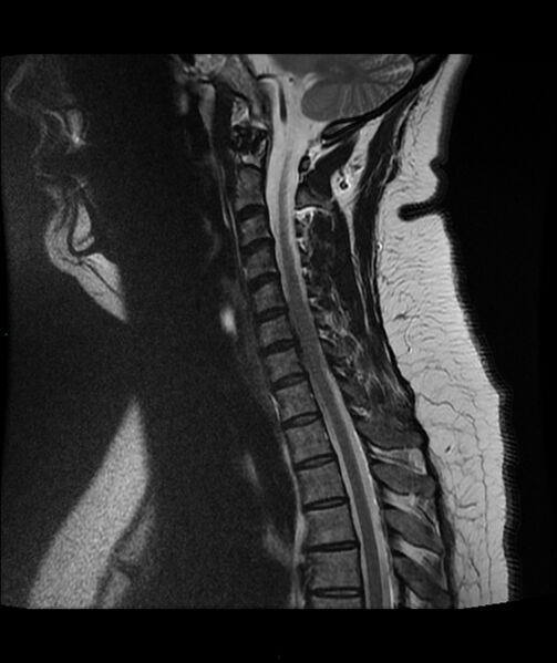 File:Cervical disc prolapse (Radiopaedia 80258-93598 Sagittal T2 6).jpg
