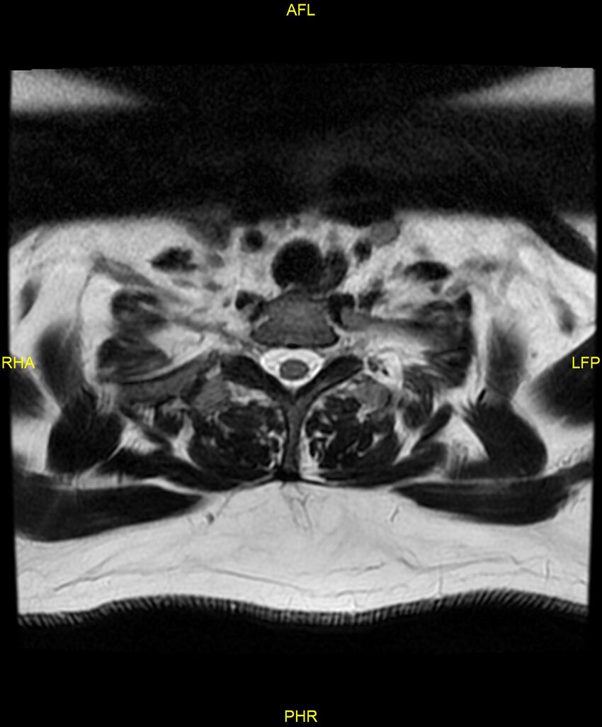 Cervical disc protrusion (Radiopaedia 87147-103415 Axial T2 79).jpg
