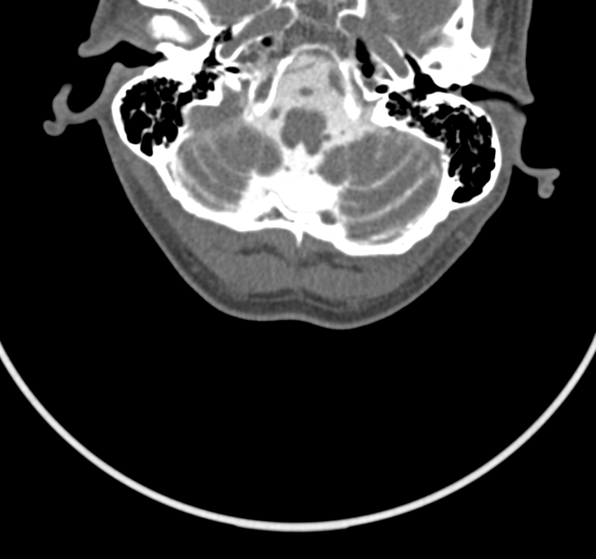 Cervical dural CSF leak on MRI and CT treated by blood patch (Radiopaedia 49748-54996 B 6).png