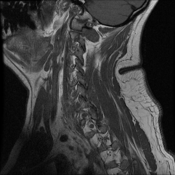 File:Cervical fracture and dislocation with locked facet (Radiopaedia 31837-32781 Sagittal T1 15).jpg