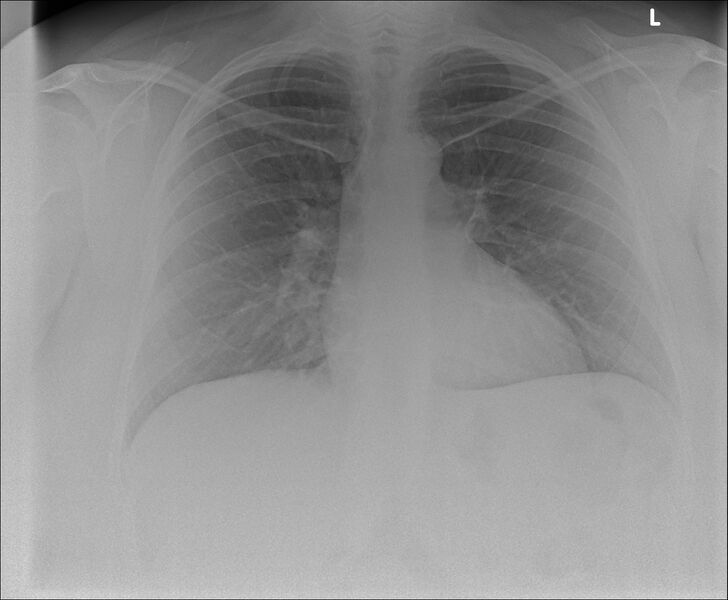 File:Cervical rib (Radiopaedia 75098).jpg