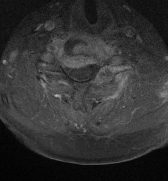 File:Cervical spondylodiscitis (Radiopaedia 81362-95110 Axial T1 C+ fat sat 12).jpg