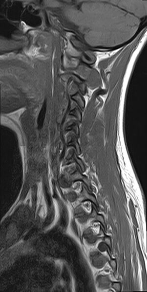 File:Cervical spondylodiscitis and calvarial hemangioma (Radiopaedia 64317-73104 Sagittal T1 10).jpg