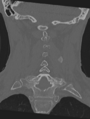 Cervical spondylolysis (Radiopaedia 49616-54811 Coronal bone window 33).png