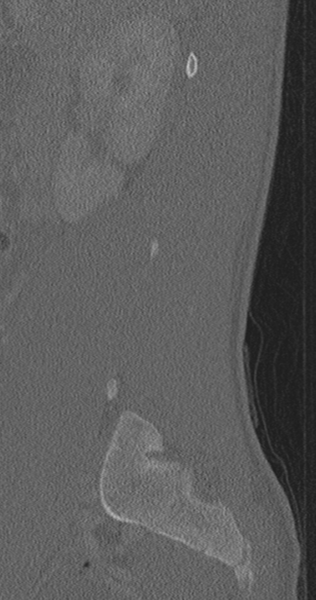 File:Chance fracture (Radiopaedia 40360-42912 Sagittal bone window 78).png