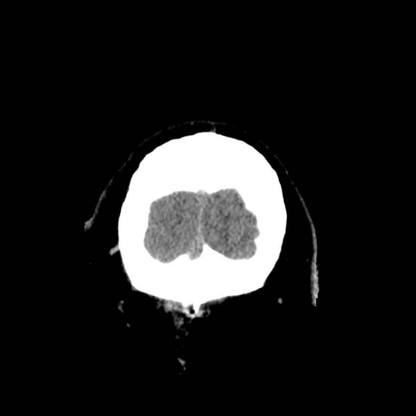 Chiasmatic-hypothalamic juvenile pilocytic astrocytoma (Radiopaedia 78533-91237 Coronal non-contrast 65).jpg