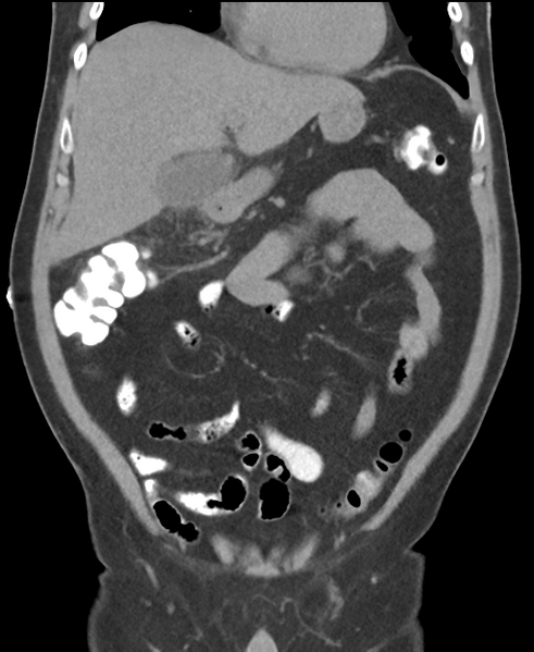 File:Cholecystitis with focal perforation and hepatic abscess (Radiopaedia 37189-38945 Coronal non-contrast 20).png