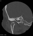 Cholesteatoma (Radiopaedia 5467-7197 Coronal bone window 1).jpg