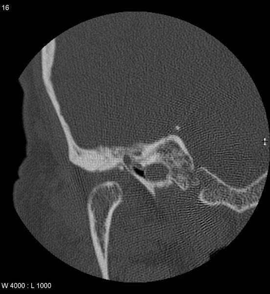 File:Cholesteatoma (Radiopaedia 5467-7197 Coronal bone window 1).jpg