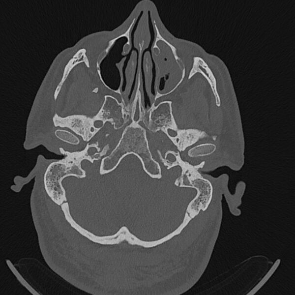 File:Cholesteatoma (Radiopaedia 68176-77673 Axial bone window 15).jpg