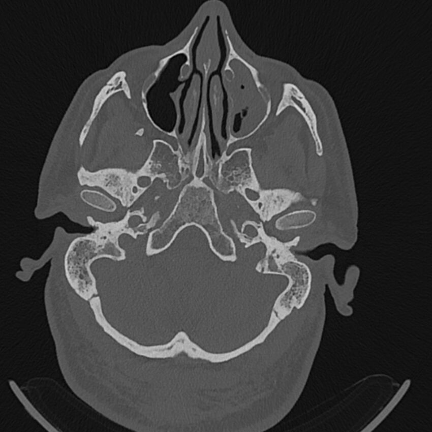 Cholesteatoma (Radiopaedia 68176-77673 Axial bone window 15).jpg