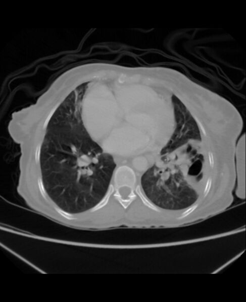 File:Chondrosarcoma (Radiopaedia 79427-92535 Axial lung window 34).jpg