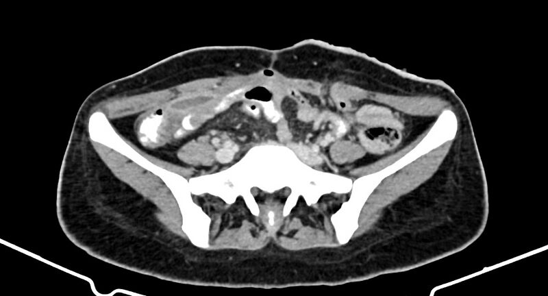 File:Choriocarcinoma liver metastases (Radiopaedia 74768-85766 A 148).jpg